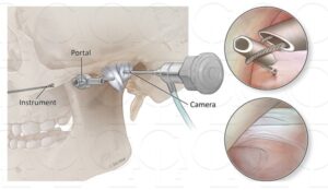 جراحی آرتروسکوپی مفصل فک چیست؟
