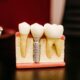 قرار دادن ایمپلنت دندان چطور انجام می گیرد؟