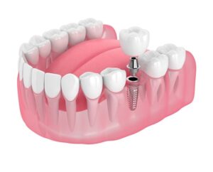 بعد از جراحی ایمپلنت دندان چه مراحلی باید طی بشه؟