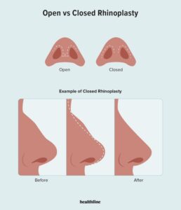 جراحی بینی open در مقایسه با جراحی close
