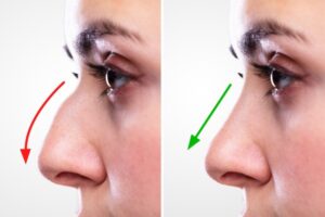 جراحی ترمیمی و مجدد بینی چگونه است؟